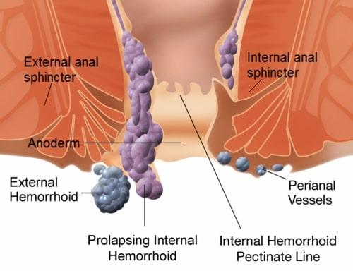 Powerful Prevention Tips That Stop Hemorrhoids From Developing Again