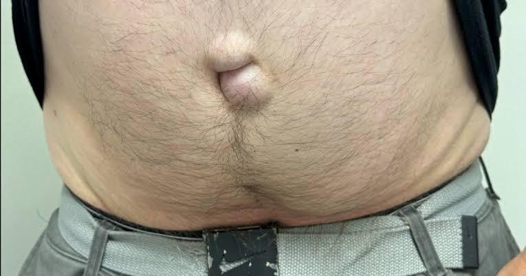 Common Mistakes People Make That Allow a Small Hernia to Grow Rapidly