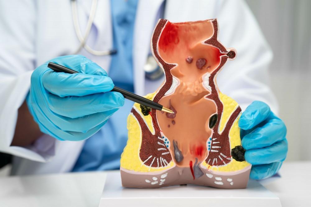 The Hidden Signs Of Hemorrhoids That Most People Fail To Notice