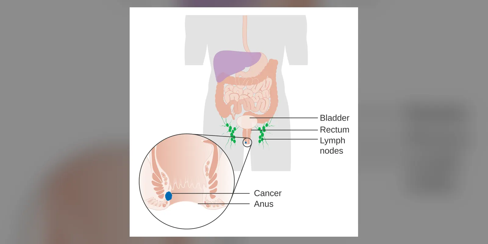 Diagram showing stage 1 anal cancer