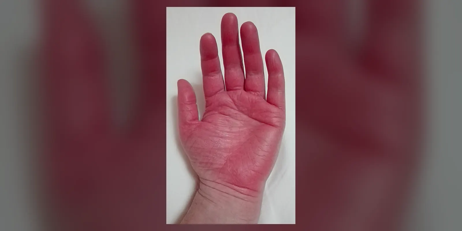 Erythromelalgia in hands of a 52-year-old Swedish man with small fiber neuropathy (sensory and autonomic), also suffering from erythromelalgia in feet and ears