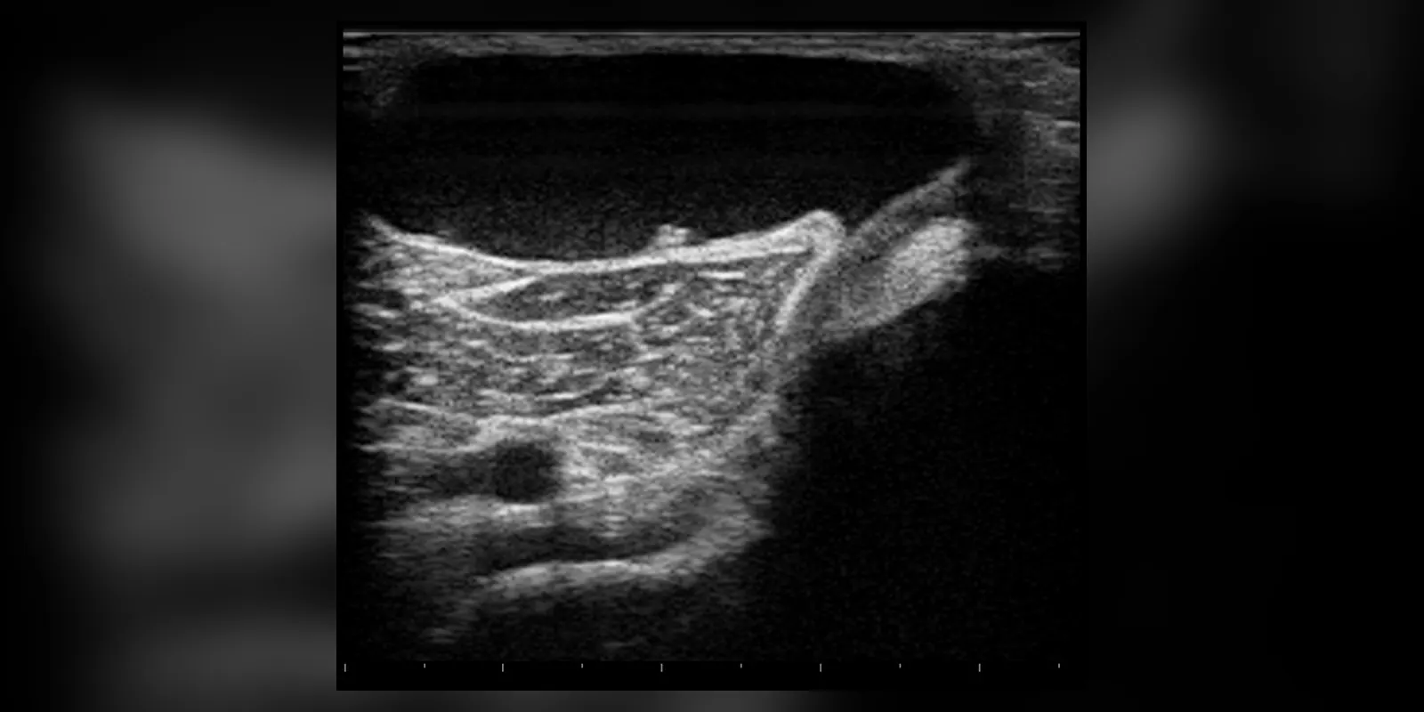 A Baker's cyst, also known as a popliteal cyst, is a benign swelling of the semimembranous bursa found behind the knee joint