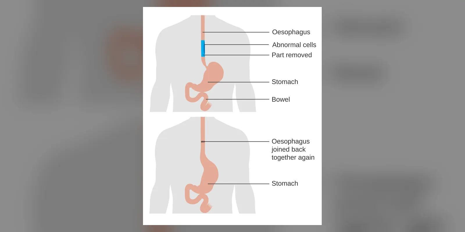 Diagram showing before and after a partial oesophagectomy for Barrett's oesophagus CRUK 478