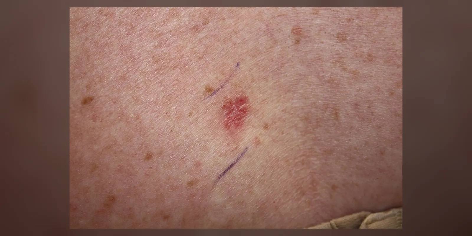 Photograph showing a skin cancer lesion (superficial basal cell carcinoma) that looks reddish brown and slightly raised