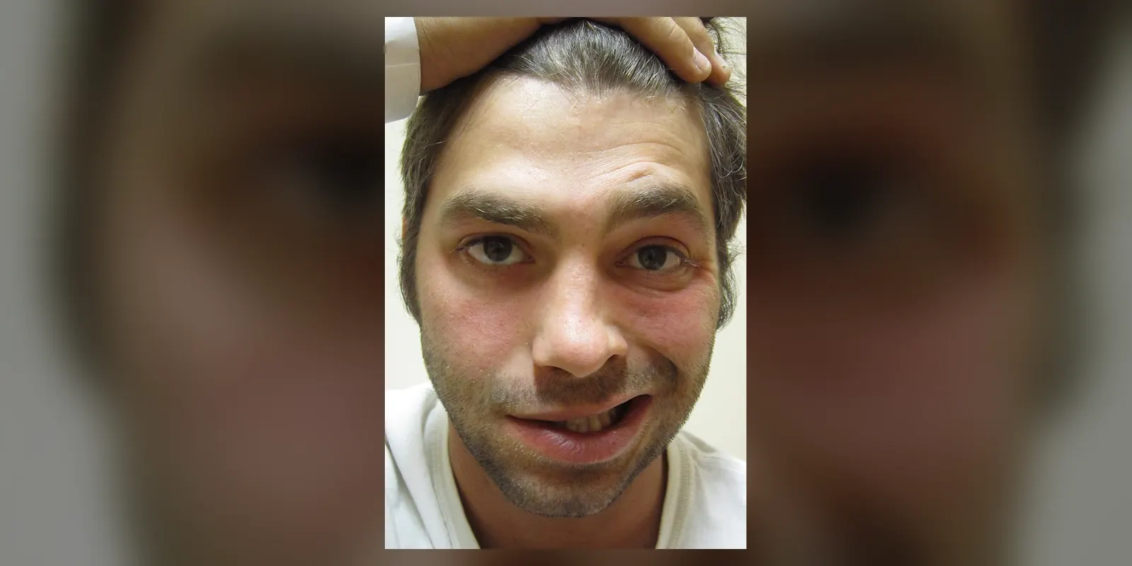 Bell's palsy: image from Wikimedia Commons