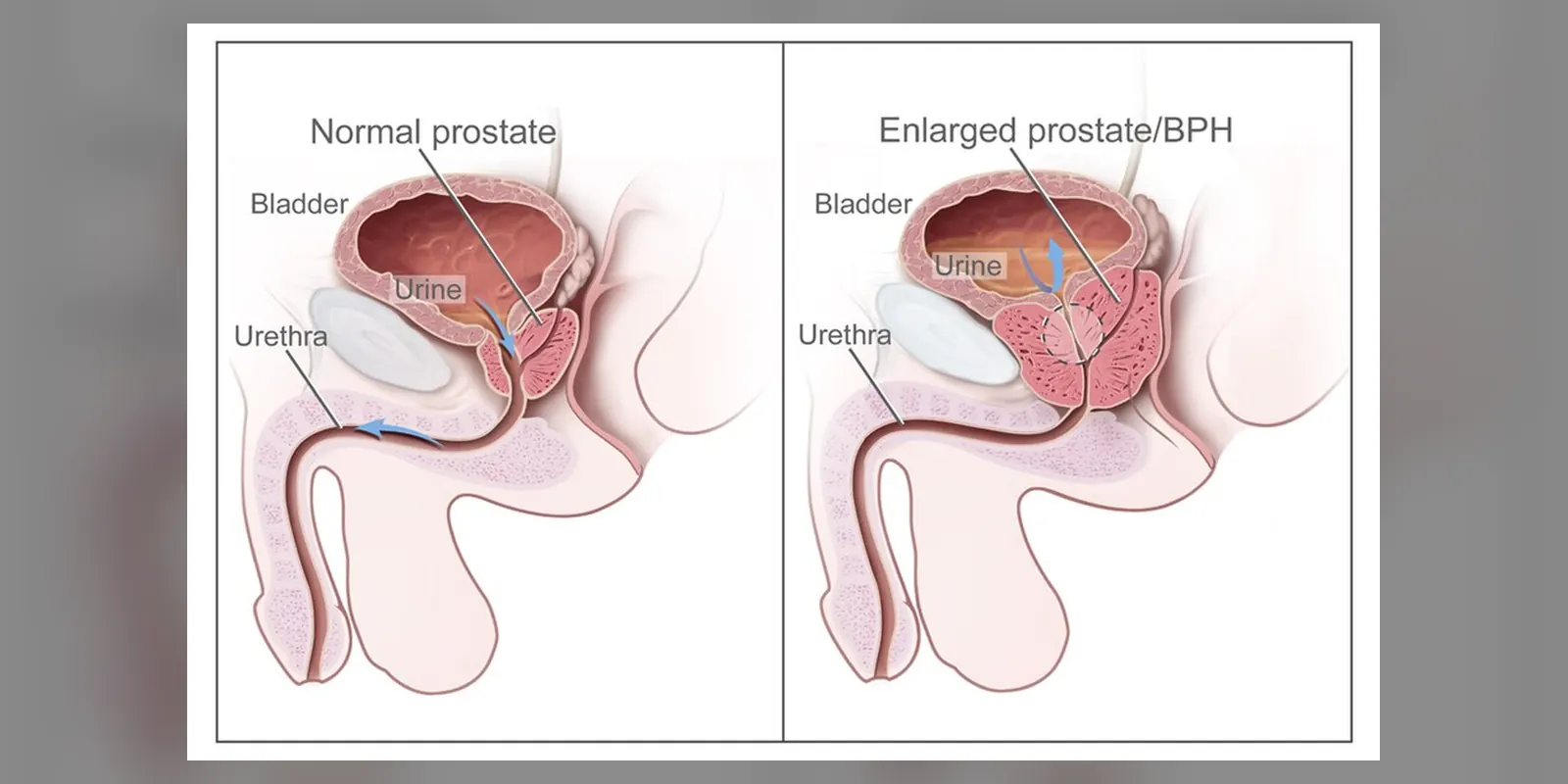 Two-panel drawing shows normal male reproductive and urinary anatomy and benign prostatic hyperplasia (BPH)