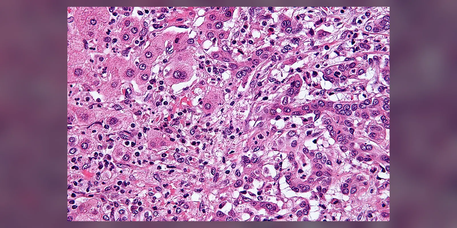 Very high magnification micrograph of cholangiocarcinoma