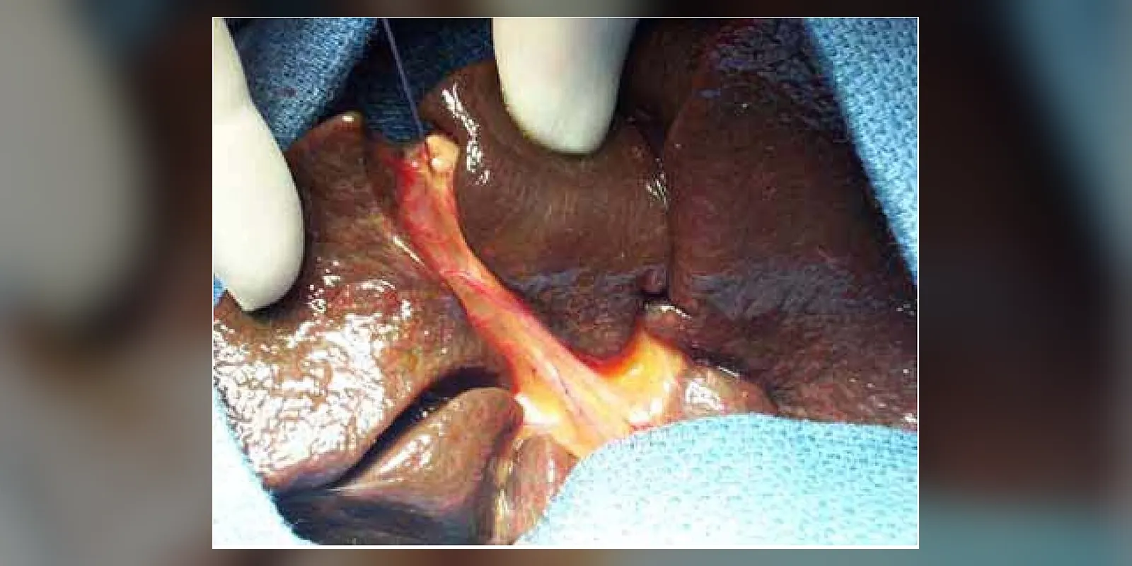 Operative view of complete extrahepatic biliary atresia