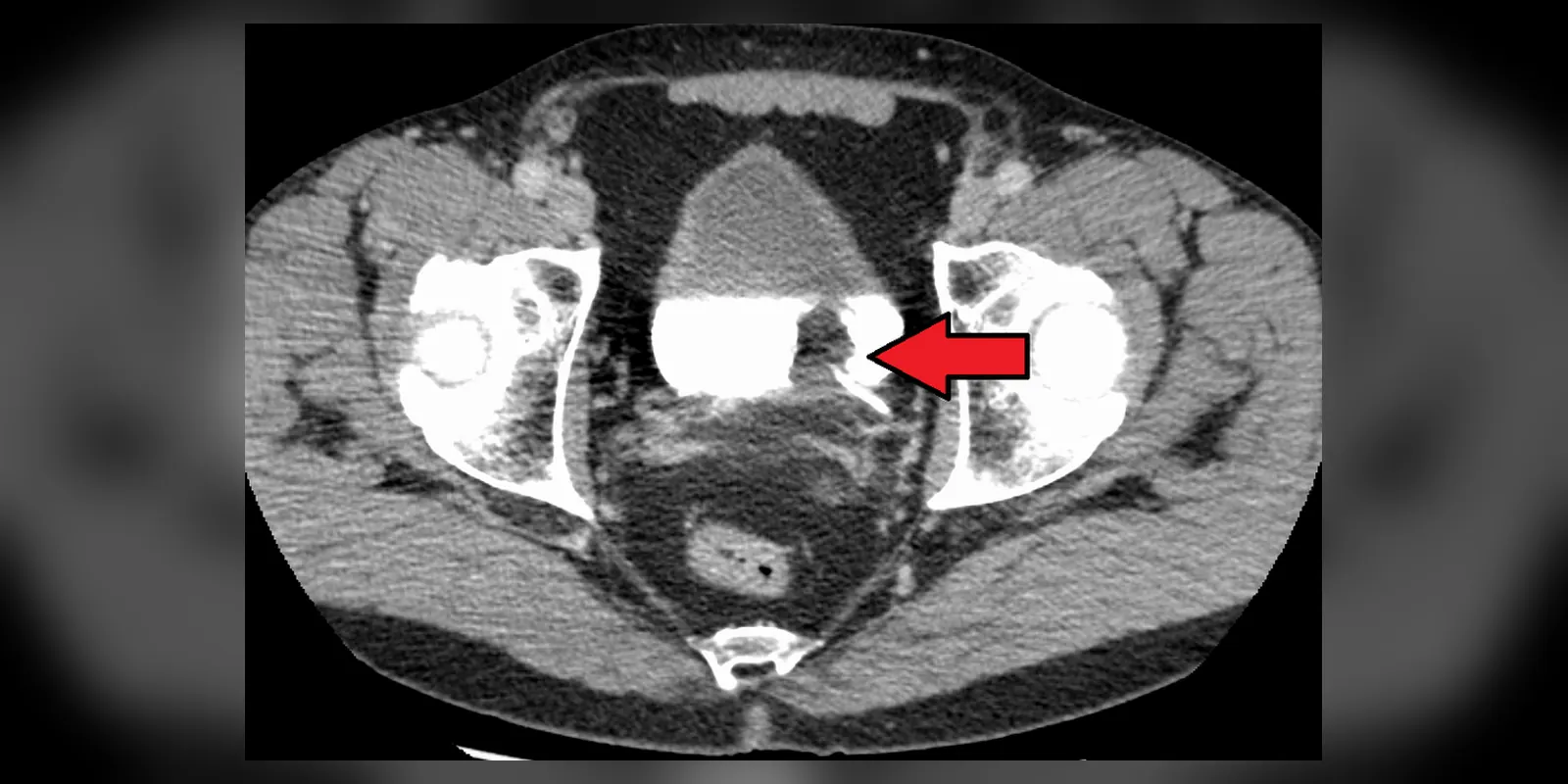 Transitional cell carcinoma of the bladder