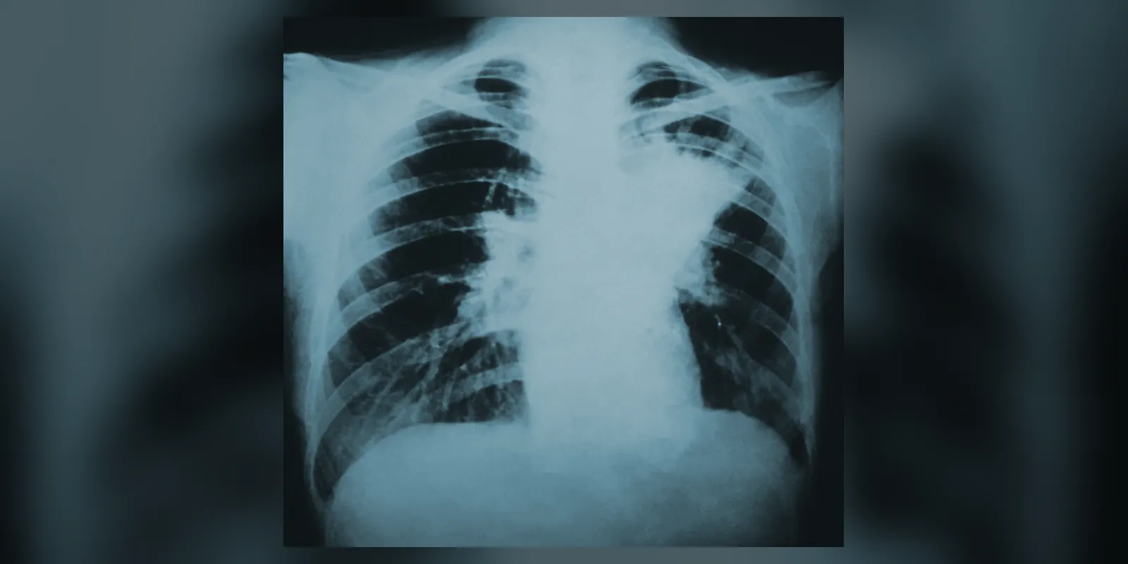 X-ray image showing infiltration of the human lungs by blastomycosis