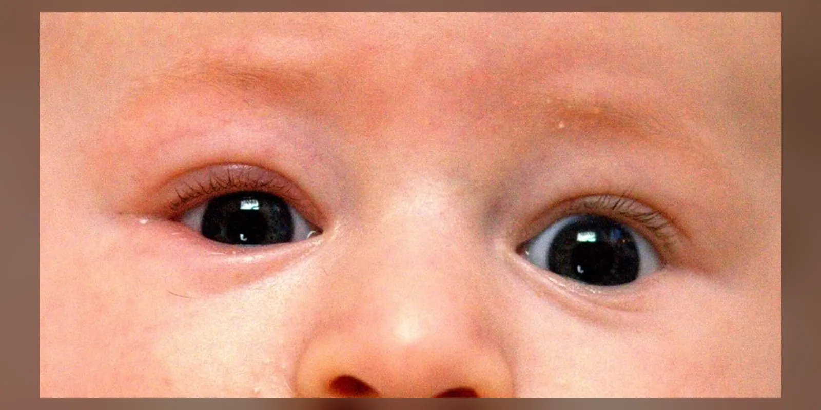 An infant with mild blepharitis (inflamed eyelids) on his right side