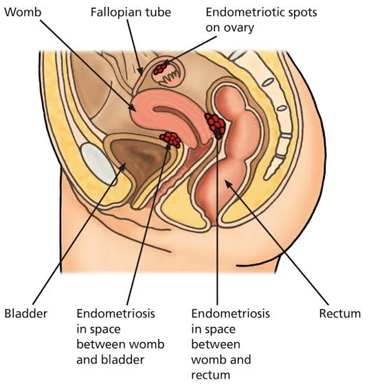 Endometriosis The Silent Disease That Can Steal a Woman’s Fertility Without Warning
