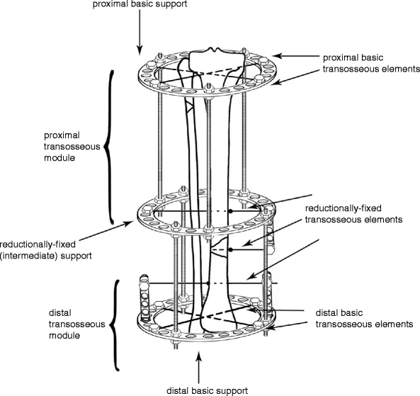 External fixation as a temporary bridge to permanent surgical bone repair