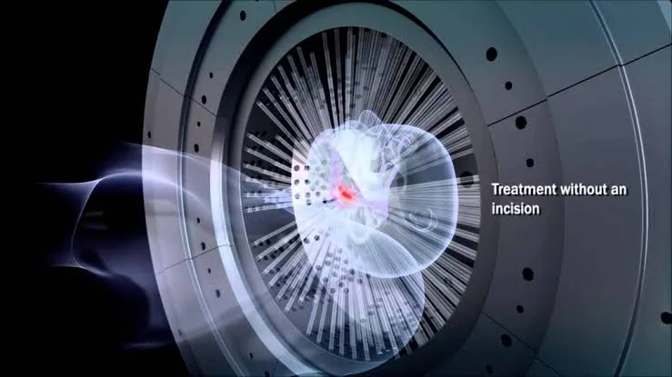 Doctors Unveil Gamma Knife Treatment That Shrinks Brain Tumors Without Traditional Surgery
