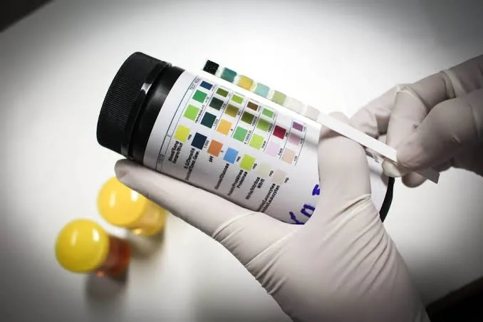 Understanding the Role of Urinalysis in Routine Health Check-ups