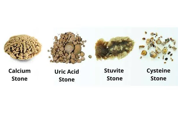 The Silent Warning Signs Your Kidneys Are Struggling Before a Stone Forms