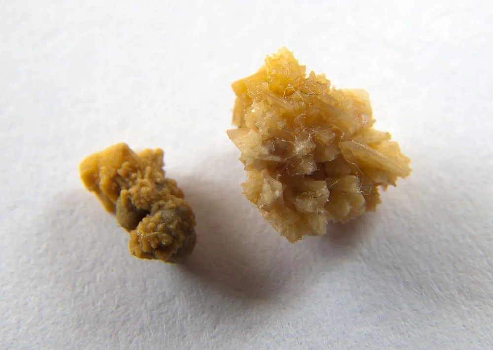 The Pain That Feels Like Fire Starting Deep in Your Lower Back Could Be Kidney Stones
