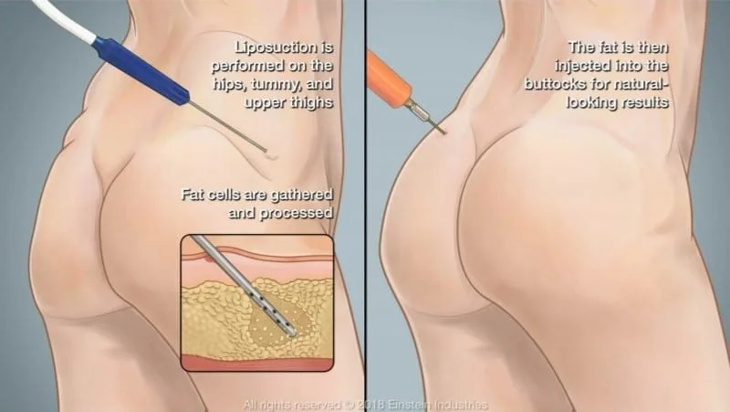 What You Must Know Before Choosing a BBL Procedure for Your Dream Shape