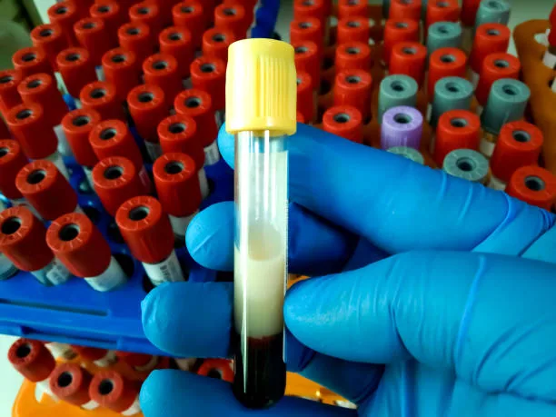 Lipid Profile: What Your Cholesterol Levels Reveal About Your Heart