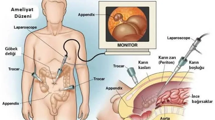 Appendectomy: Everything You Need to Know Before, During, and After Surgery