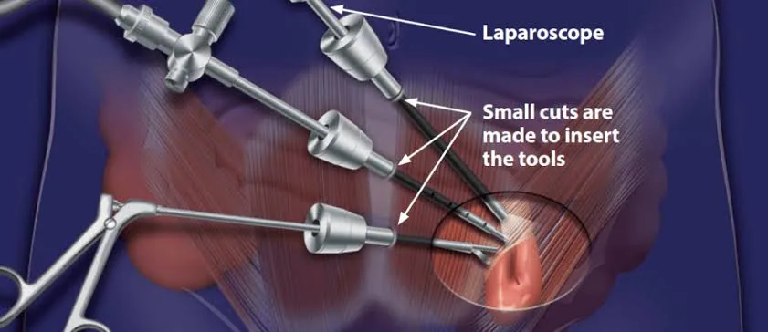 Hernia Repair Fixing a hernia to prevent complications