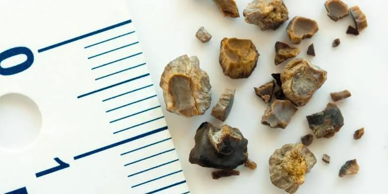 Gallbladder Removal (Cholecystectomy): Treating Gallstones and Gallbladder Disease