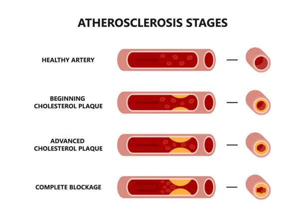 9 Silent Signs of Artery Blockages You Can't Ignore: Protect Your Heart Now!
