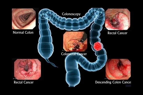 10 Silent Signs of Colon Cancer You Can't Ignore Protect Yourself Today