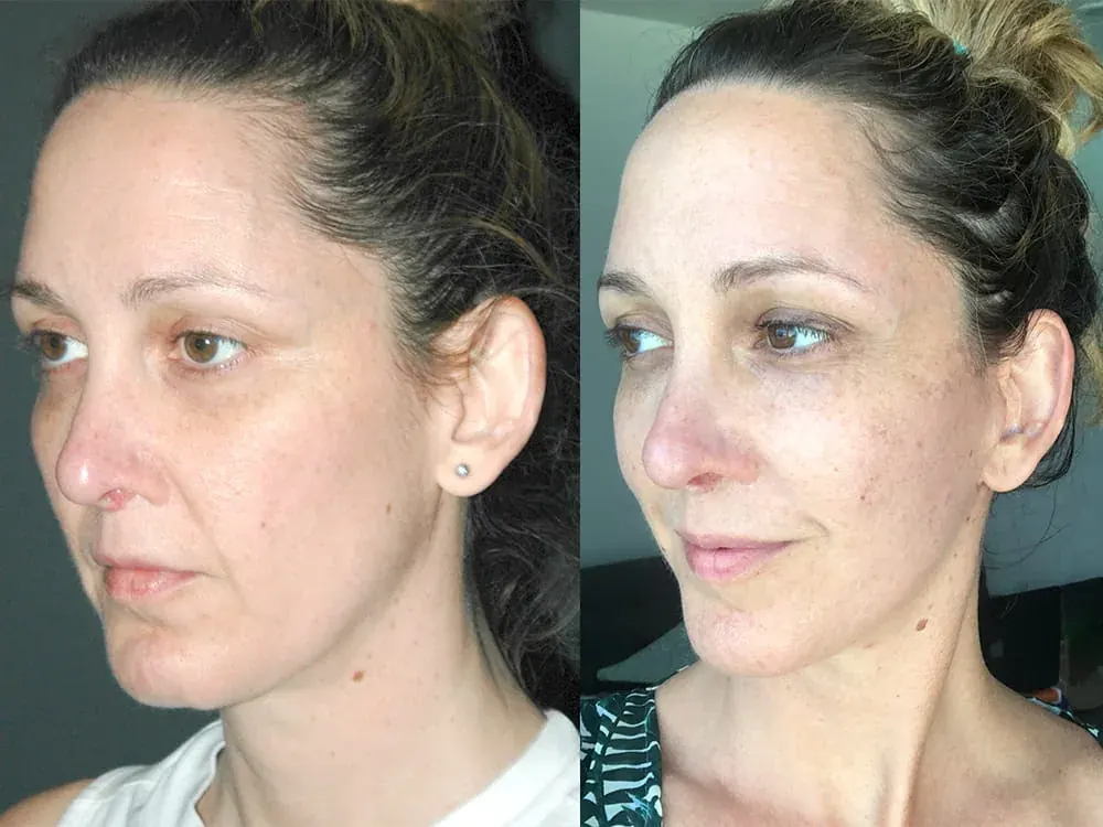 Facelifts vs Mini Facelifts: What’s Right for Your Skin and Age?