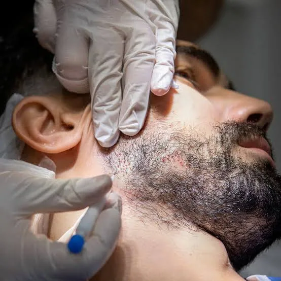 Beard Transplants Explained: The Permanent Solution to a Thicker Beard