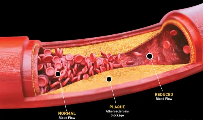 Why Medications Can’t Clear a 90% Blocked Artery and When You Need a Stent