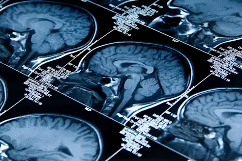 What Science Says About Ignored Headaches and the Risk of Sudden Death