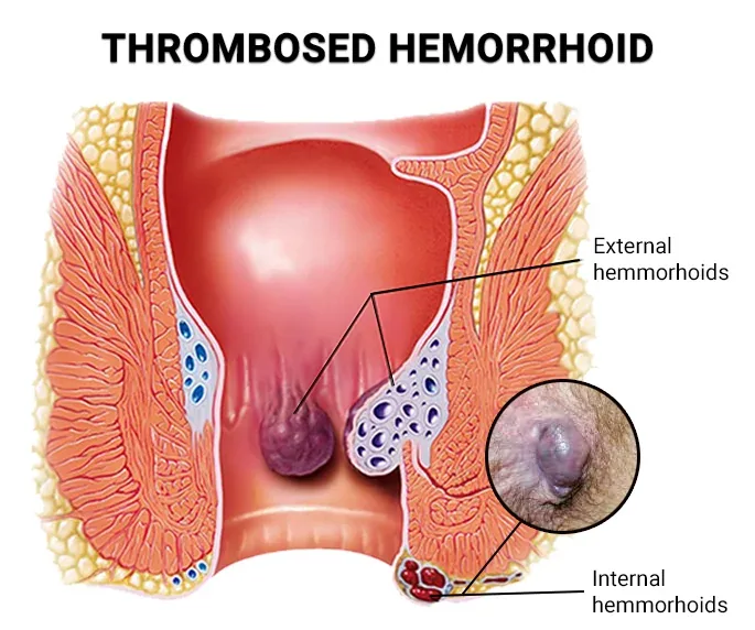 The Hidden Signs Of Hemorrhoids That Most People Fail To Notice