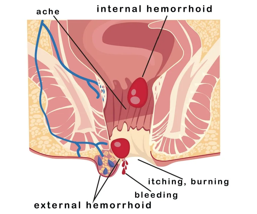 The Surprising Link Between Constipation And The Silent Growth Of Hemorrhoids