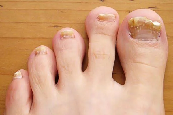 What Your Feet May Be Telling You About Your Health: Key Signs to Watch For