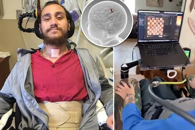 How Brain Implants Are Transforming Healthcare and Medical Treatments