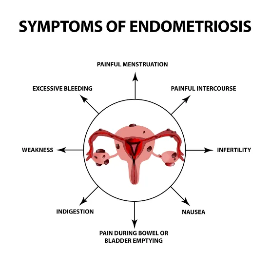 Endometriosis The Silent Disease That Can Steal a Woman’s Fertility Without Warning