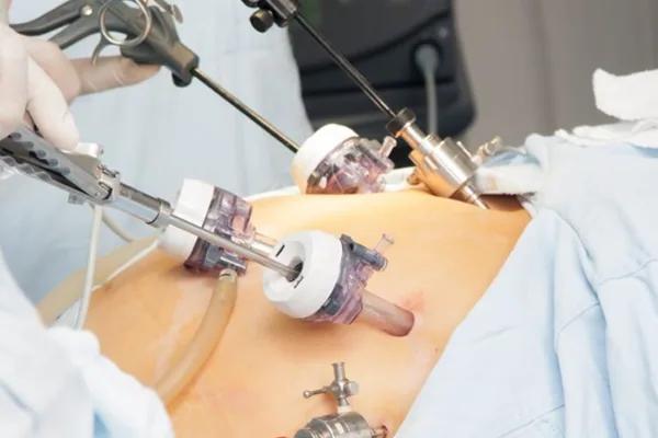 Why Medical Institutions Are Rapidly Adopting 3D Camera Laparoscopic Surgical Systems