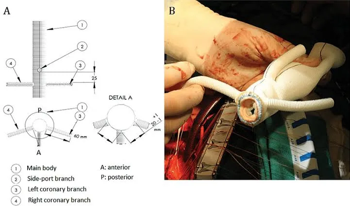 Breaking Down the Science Behind Successful Artery Replacement Procedures