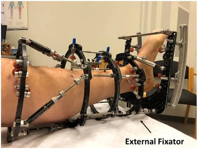 External fixation as a temporary bridge to permanent surgical bone repair