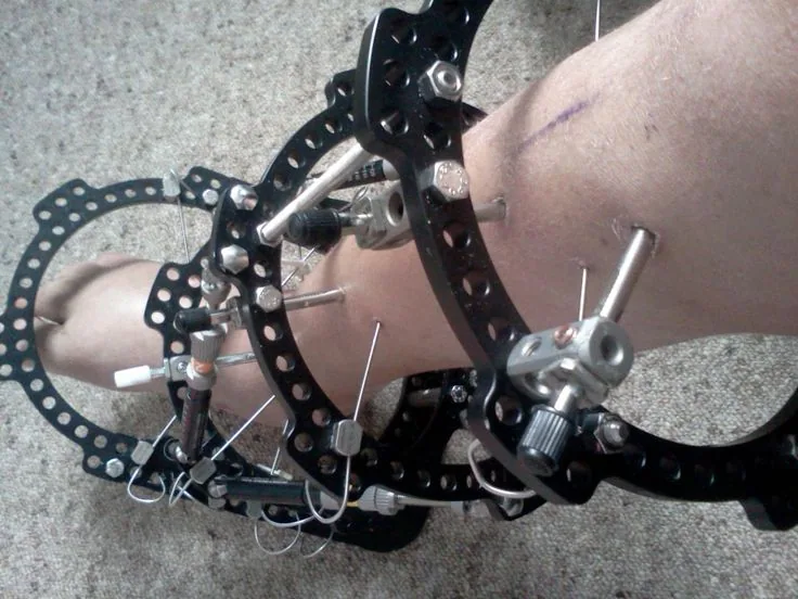 External fixation as a temporary bridge to permanent surgical bone repair