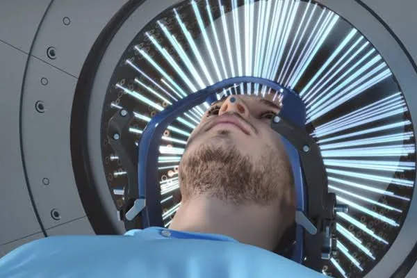 Doctors Unveil Gamma Knife Treatment That Shrinks Brain Tumors Without Traditional Surgery