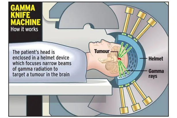 Doctors Unveil Gamma Knife Treatment That Shrinks Brain Tumors Without Traditional Surgery