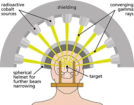 Doctors Unveil Gamma Knife Treatment That Shrinks Brain Tumors Without Traditional Surgery