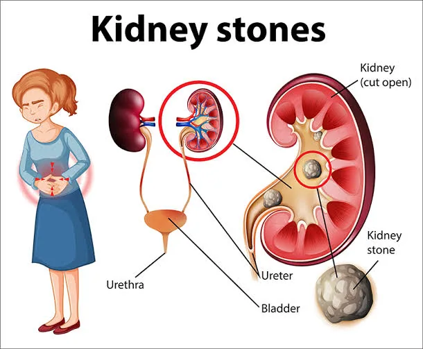 The Silent Warning Signs Your Kidneys Are Struggling Before a Stone Forms