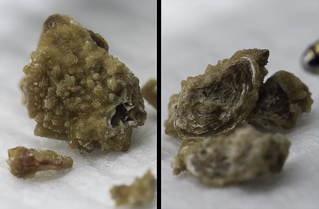 The Silent Warning Signs Your Kidneys Are Struggling Before a Stone Forms