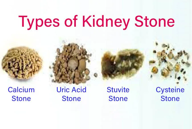 The Pain That Feels Like Fire Starting Deep in Your Lower Back Could Be Kidney Stones