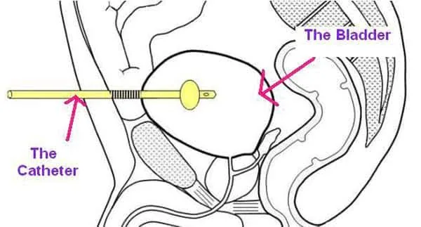 Why Doctors Prefer Suprapubic Catheters Over Regular Urinary Catheters in Some Cases