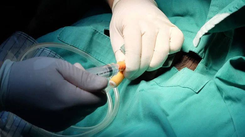 Why Doctors Prefer Suprapubic Catheters Over Regular Urinary Catheters in Some Cases
