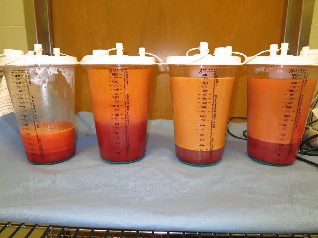 Why BBL Surgery Has Become the Most Talked About Body Procedure Today